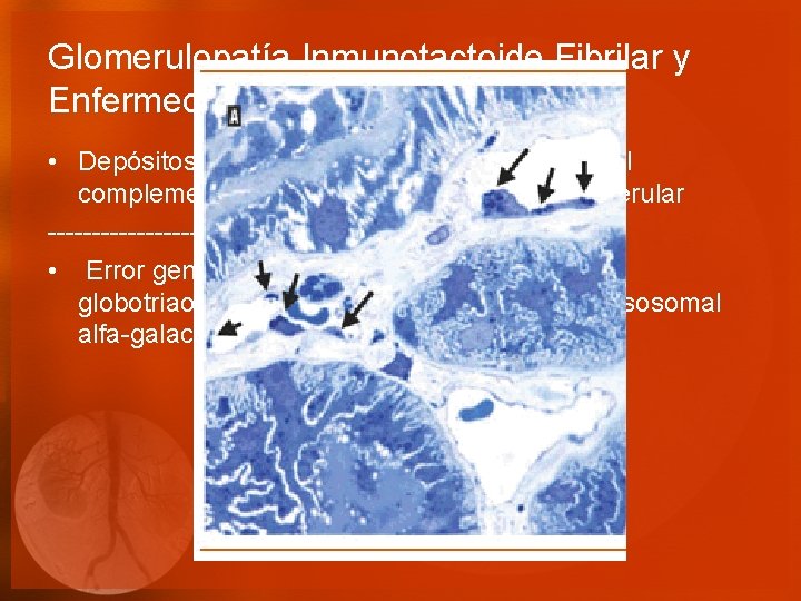 Glomerulopatía Inmunotactoide Fibrilar y Enfermedad de Fabry • Depósitos de inmunoglobulina oligoclonal y del