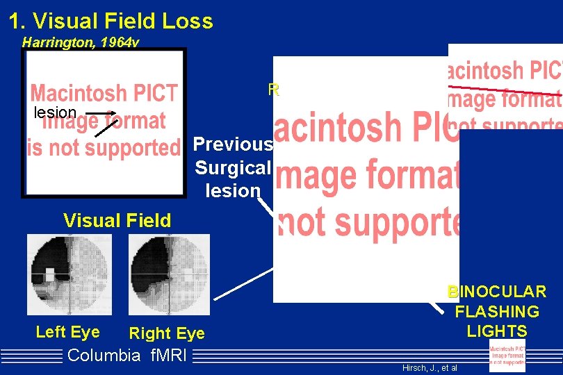 1. Visual Field Loss Harrington, 1964 v R lesion Previous Surgical lesion Visual Field