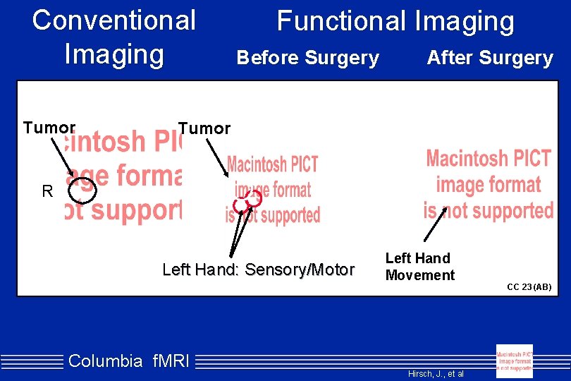 Conventional Imaging Tumor Functional Imaging Before Surgery After Surgery Tumor R Left Hand: Sensory/Motor