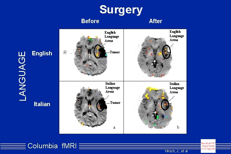 Surgery Before After LANGUAGE English Language Areas English R Tumor Italian Language Areas Tumor