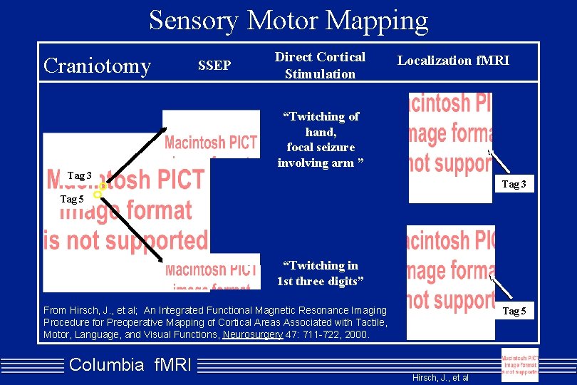 Sensory Motor Mapping Craniotomy SSEP Direct Cortical Stimulation Localization f. MRI “Twitching of hand,