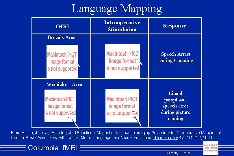 Language Mapping f. MRI Intraoperative Stimulation Response Broca’s Area Speech Arrest During Counting Wernicke’s