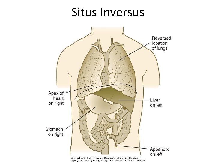 Situs Inversus 