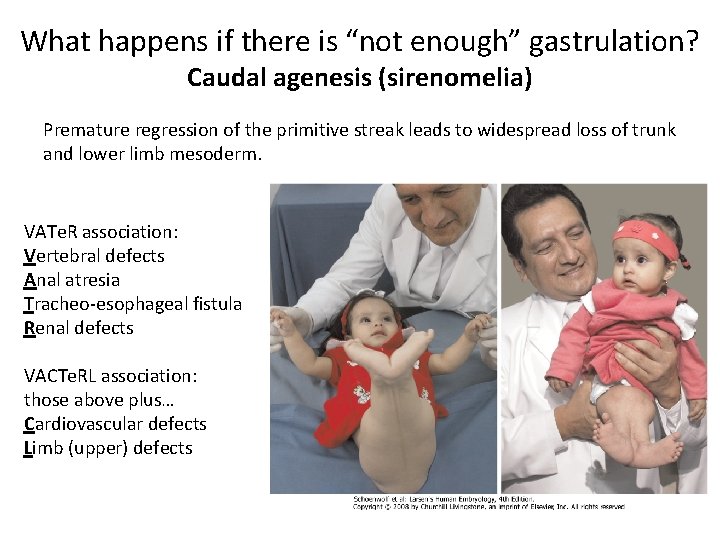What happens if there is “not enough” gastrulation? Caudal agenesis (sirenomelia) Premature regression of