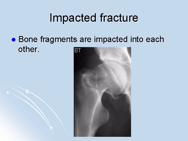 Impacted fracture l Bone fragments are impacted into each other. 