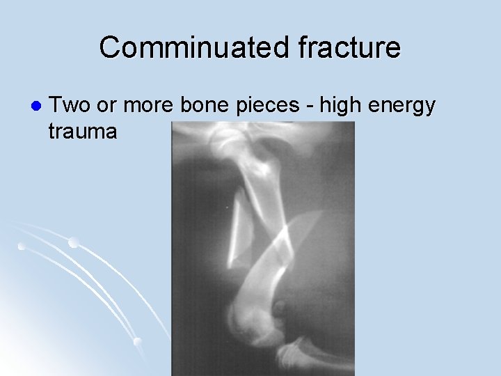 Comminuated fracture l Two or more bone pieces - high energy trauma 