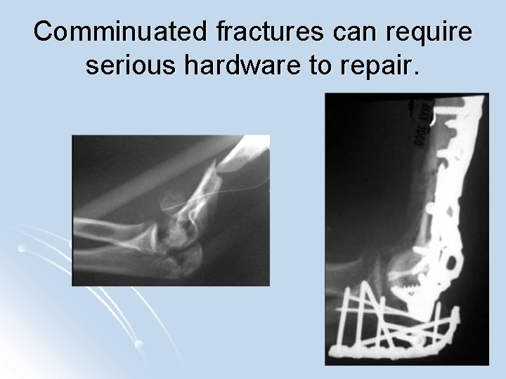 Comminuated fractures can require serious hardware to repair. 