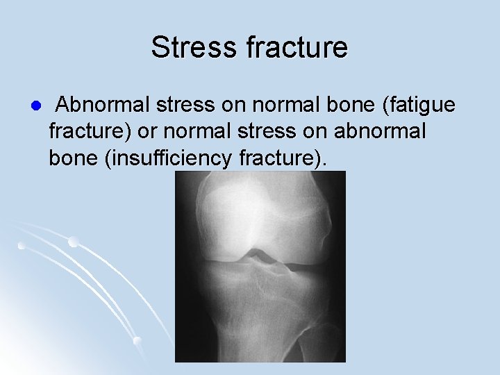 Stress fracture l Abnormal stress on normal bone (fatigue fracture) or normal stress on