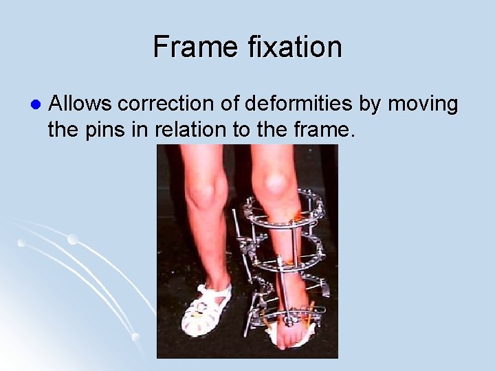 Frame fixation l Allows correction of deformities by moving the pins in relation to