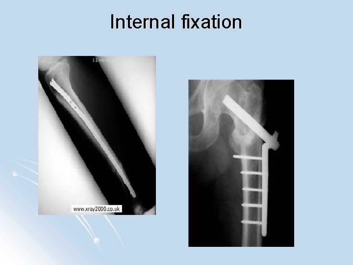 Internal fixation 