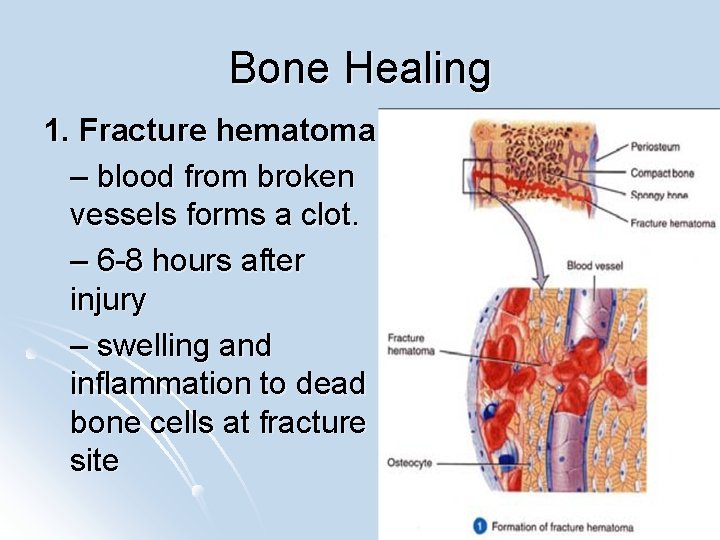 Bone Healing 1. Fracture hematoma – blood from broken vessels forms a clot. –