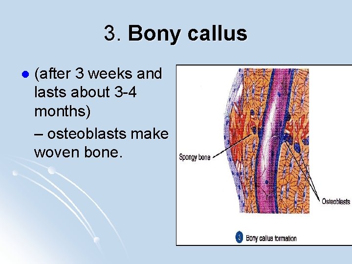 3. Bony callus l (after 3 weeks and lasts about 3 -4 months) –