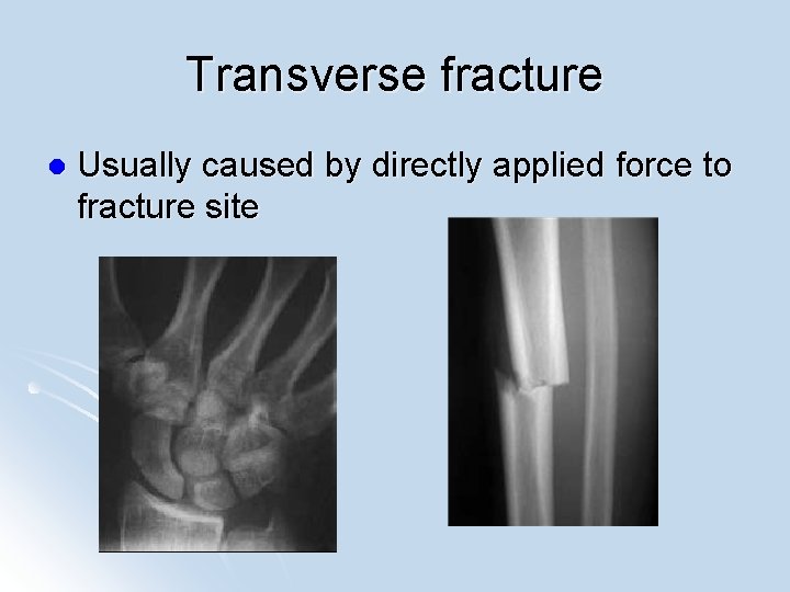 Transverse fracture l Usually caused by directly applied force to fracture site 