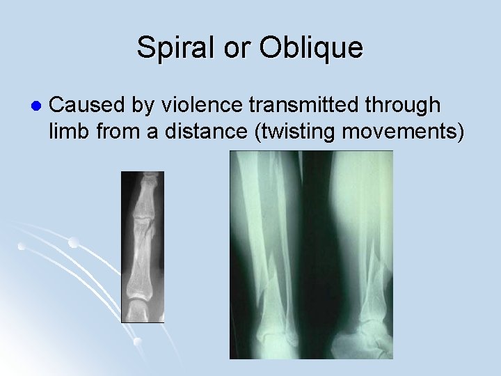 Spiral or Oblique l Caused by violence transmitted through limb from a distance (twisting