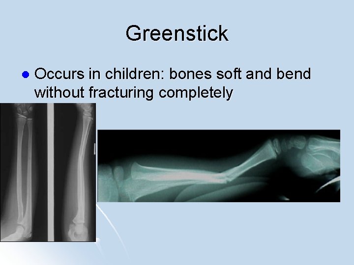 Greenstick l Occurs in children: bones soft and bend without fracturing completely 