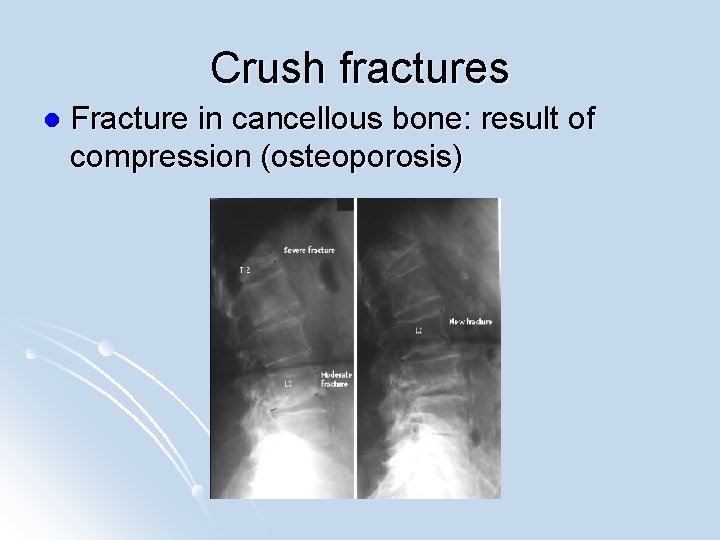 Crush fractures l Fracture in cancellous bone: result of compression (osteoporosis) 