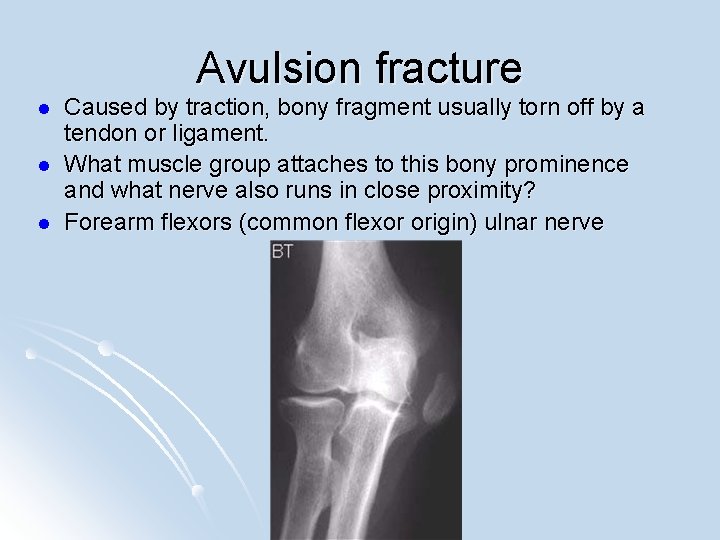 Avulsion fracture l l l Caused by traction, bony fragment usually torn off by