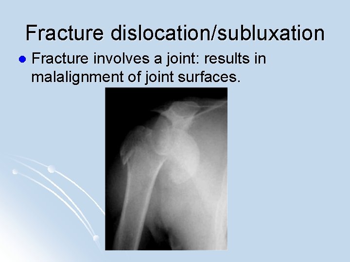 Fracture dislocation/subluxation l Fracture involves a joint: results in malalignment of joint surfaces. 