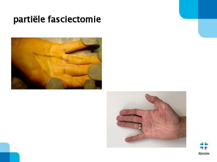 partiële fasciectomie 