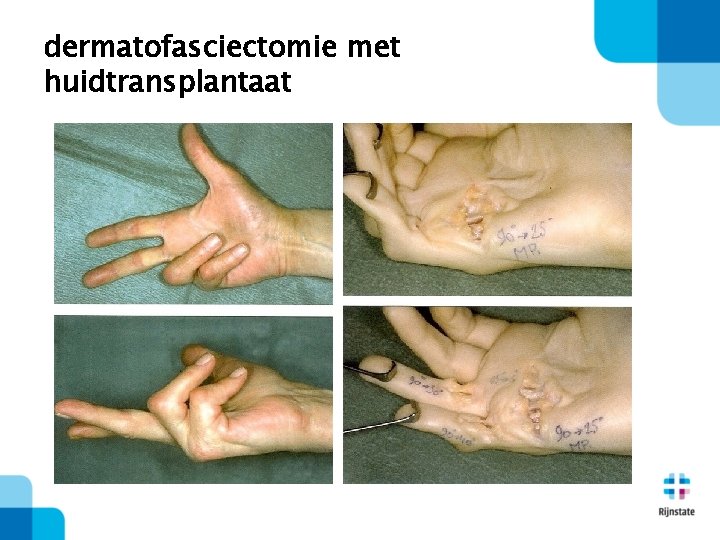 dermatofasciectomie met huidtransplantaat 
