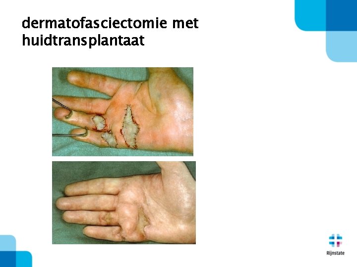 dermatofasciectomie met huidtransplantaat 