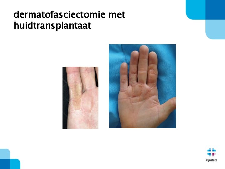 dermatofasciectomie met huidtransplantaat 