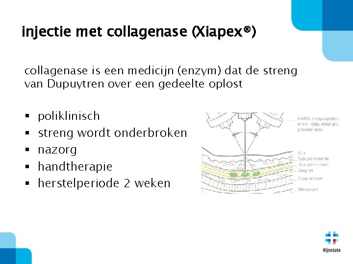 injectie met collagenase (Xiapex®) collagenase is een medicijn (enzym) dat de streng van Dupuytren