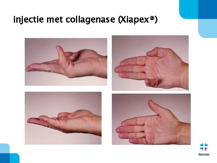 injectie met collagenase (Xiapex®) 