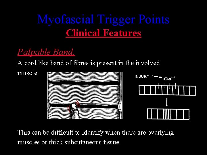 Myofascial Trigger Points Clinical Features Palpable Band. A cord like band of fibres is