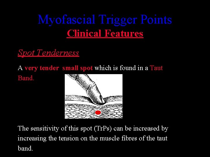 Myofascial Trigger Points Clinical Features Spot Tenderness A very tender small spot which is