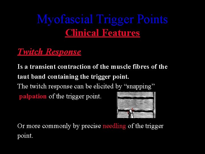 Myofascial Trigger Points Clinical Features Twitch Response Is a transient contraction of the muscle