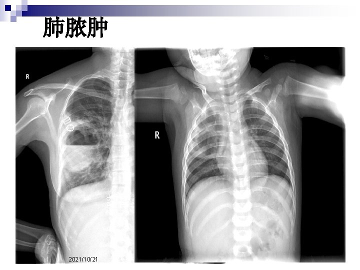 肺脓肿 2021/10/21 27 