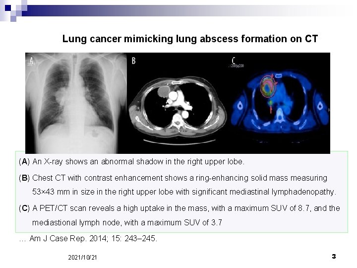 Lung cancer mimicking lung abscess formation on CT (A) An X-ray shows an abnormal