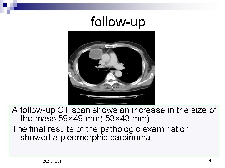 follow-up A follow-up CT scan shows an increase in the size of the mass