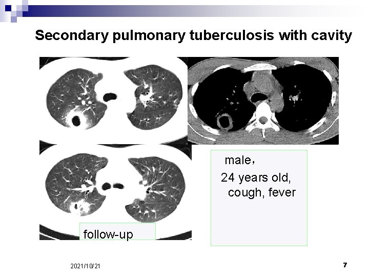 Secondary pulmonary tuberculosis with cavity male， 24 years old, cough, fever follow-up 2021/10/21 7