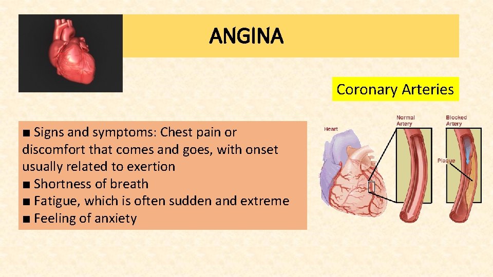 ANGINA Coronary Arteries ■ Signs and symptoms: Chest pain or discomfort that comes and