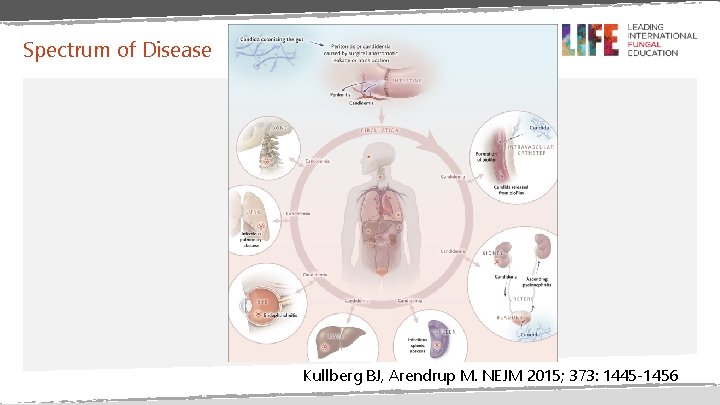 Spectrum of Disease Kullberg BJ, Arendrup M. NEJM 2015; 373: 1445 -1456 