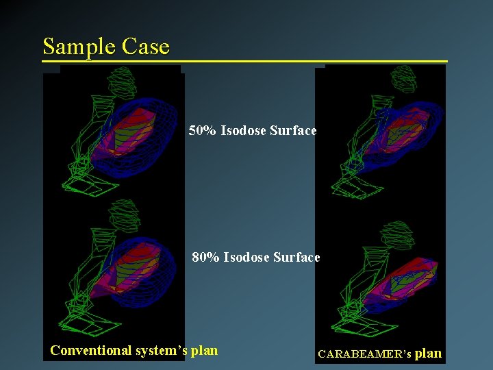 Sample Case 50% Isodose Surface 80% Isodose Surface Conventional system’s plan CARABEAMER’s plan 