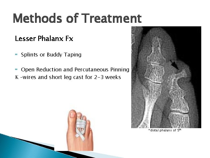Methods of Treatment Lesser Phalanx Fx Splints or Buddy Taping Open Reduction and Percutaneous
