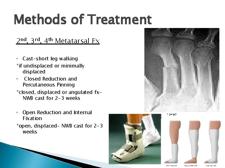 Methods of Treatment 2 nd, 3 rd, 4 th Metatarsal Fx Cast-short leg walking