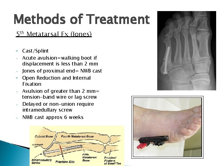 Methods of Treatment 5 th Metatarsal Fx (Jones) • • • Cast/Splint Acute avulsion=walking