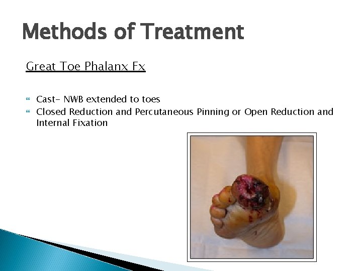 Methods of Treatment Great Toe Phalanx Fx Cast- NWB extended to toes Closed Reduction