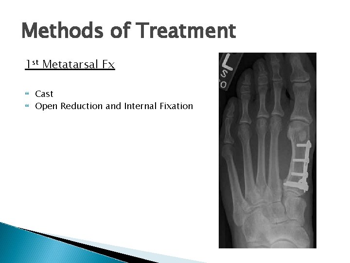 Methods of Treatment 1 st Metatarsal Fx Cast Open Reduction and Internal Fixation 