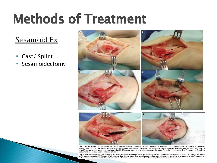 Methods of Treatment Sesamoid Fx Cast/ Splint Sesamoidectomy 