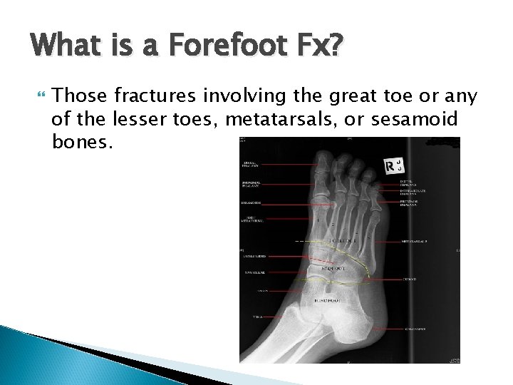 What is a Forefoot Fx? Those fractures involving the great toe or any of