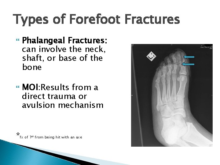 Types of Forefoot Fractures Phalangeal Fractures: can involve the neck, shaft, or base of