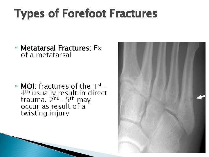 Types of Forefoot Fractures Metatarsal Fractures: Fx of a metatarsal MOI: fractures of the