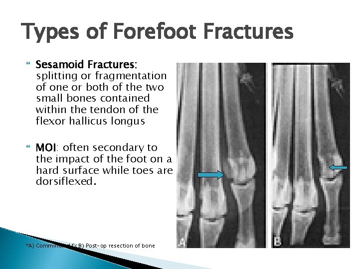 Types of Forefoot Fractures Sesamoid Fractures: splitting or fragmentation of one or both of