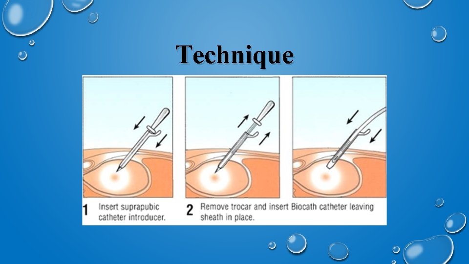 SUPRAPUBIC CATHETER INSERTION PREPARED BY SHANE BARCLAY MD