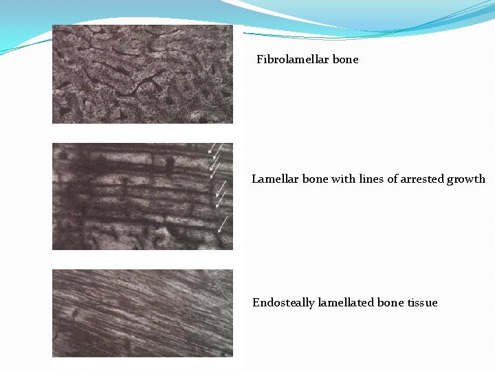 Fibrolamellar bone Lamellar bone with lines of arrested growth Endosteally lamellated bone tissue 